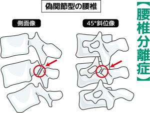 腰椎分離症